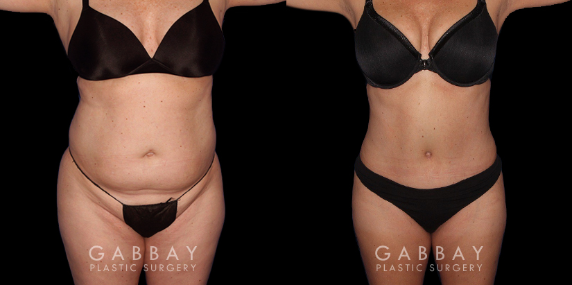 Abdomen and Waist Liposuction - Before and After Photos