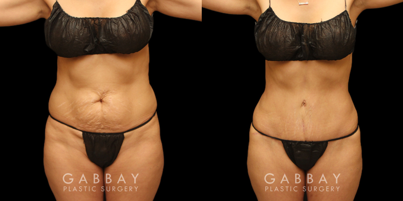 Tummy Tuck With 360 Body Contouring