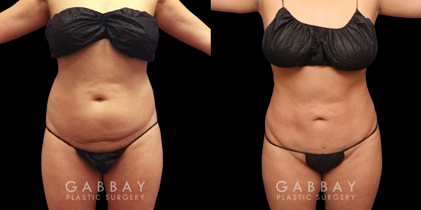 Abdominoplasty before and after photos post-recovery. Patient’s healing went smoothly, resulting in a firmer, tighter abdominal region, with a refined contour particularly visible in side profile.