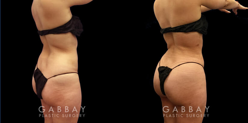 Fat Transfer Buttock Augmentation Beverly Hills - For Thin Women
