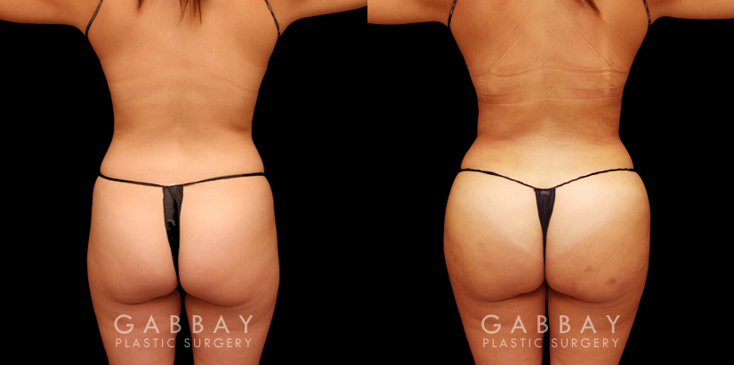 Liposuction 360 with Fat Transfer: The Ultimate Brazilian Butt Lift  Procedure. 