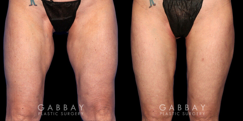 Thigh Lift Before and After Photo Gallery