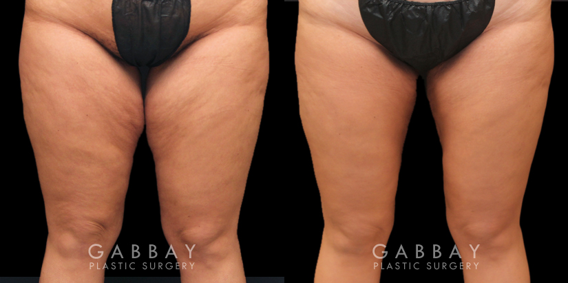 Thigh Lift Surgery in Mexico - VIDA Wellness and Beauty