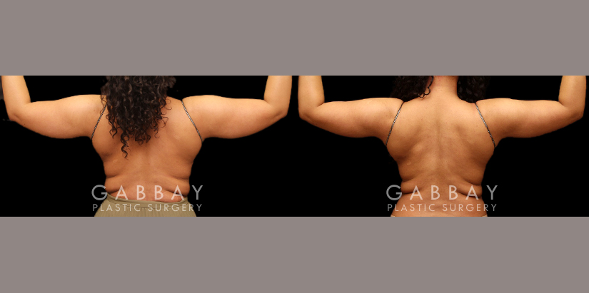 Lipo Arms Before and After Photo Gallery