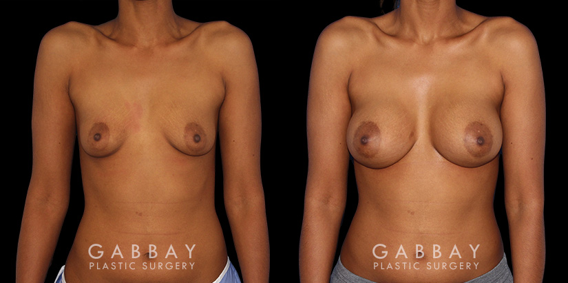 Silicone implants were used to increase breast volume while preserving the patient’s natural breast shape. The increased bust size resulted in a feminine, refined profile.