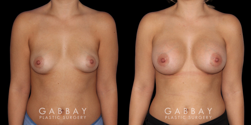 Silicone implants used to increase breast size in female patient in her 30s. Boost ot breast volume resulted in a more feminine contour from each before-and-after photo angle.