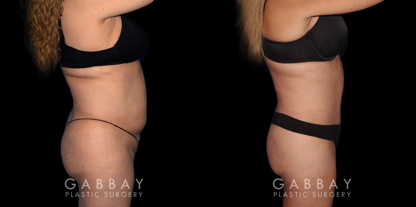 Abdomen Lipo Before and After Photo Gallery