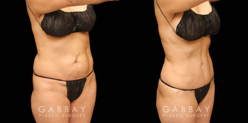 Before and After Plastic Surgery: Tummy Tuck