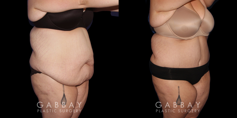 Abdominoplasty patient results, highlighting the loose skin and folds before the procedure. Following surgery, the patient recovered without complications and saw lasting tummy tuck results with a flatter profile.