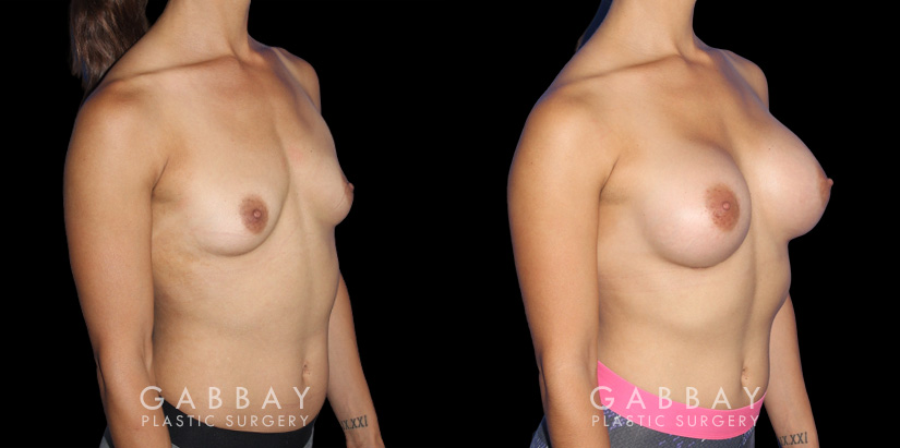 Patient recovered without complication and maintained a round, pleasing shape to her breasts. Scarring is hidden in the breasts natural folds, displaying only her positive results.