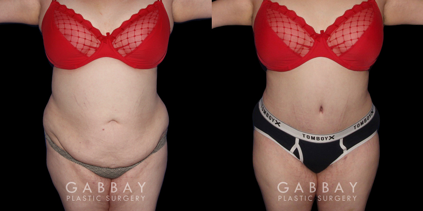 Patient before and after her tummy tuck procedure combined with liposuction around the waist. The final effect is slimming from multiple angles with no visible scarring. Note the smoother texture of skin and lending to a more youthful visual.