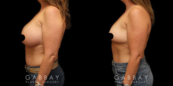 Breast Implant Removal Beverly Hills