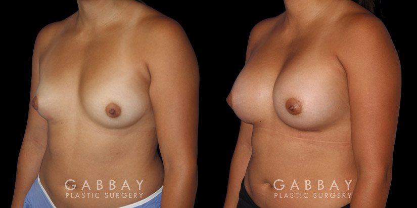 Breast Augmentation before-and-after photos demonstrating increased breast volume using silicone implants. Patient sought a milder increase to bust while keeping the volume within a natural range.