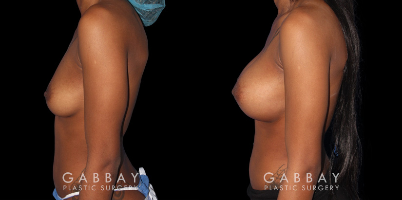 Patient with significant breast volume increase through breast augmentation with silicone implants. Profile view demonstrates the enhanced breast size by silhouette with an alluring, round shape.