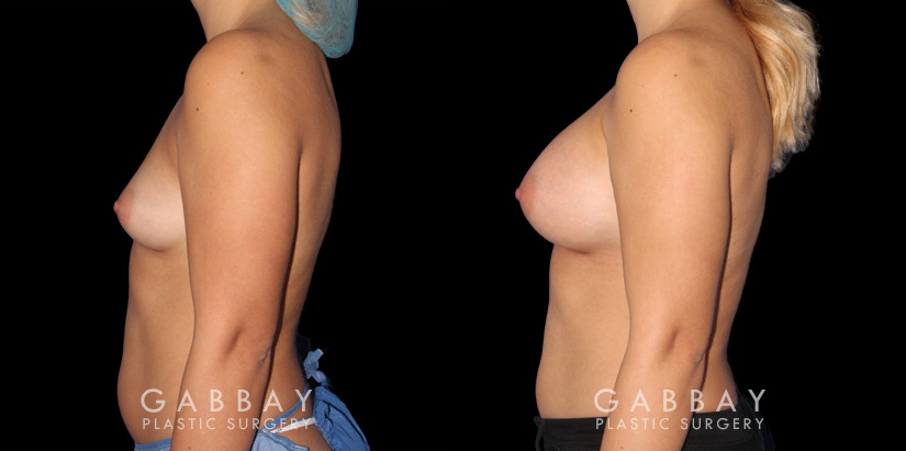 Silicone implants used to increase breast size in female patient in her 30s. Boost ot breast volume resulted in a more feminine contour from each before-and-after photo angle.