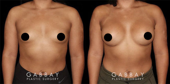 Breast implants before and after pregnancy