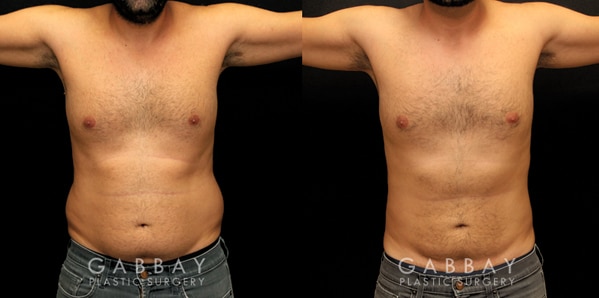 Beverly Hills Breast Reconstruction Surgery - Nipple Reconstruction Los  Angeles, California