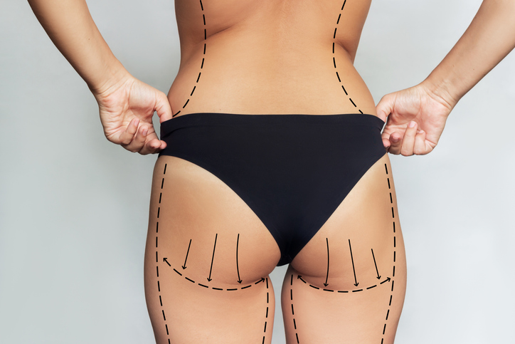 Featured image for How Is a Brazilian Butt Lift Performed