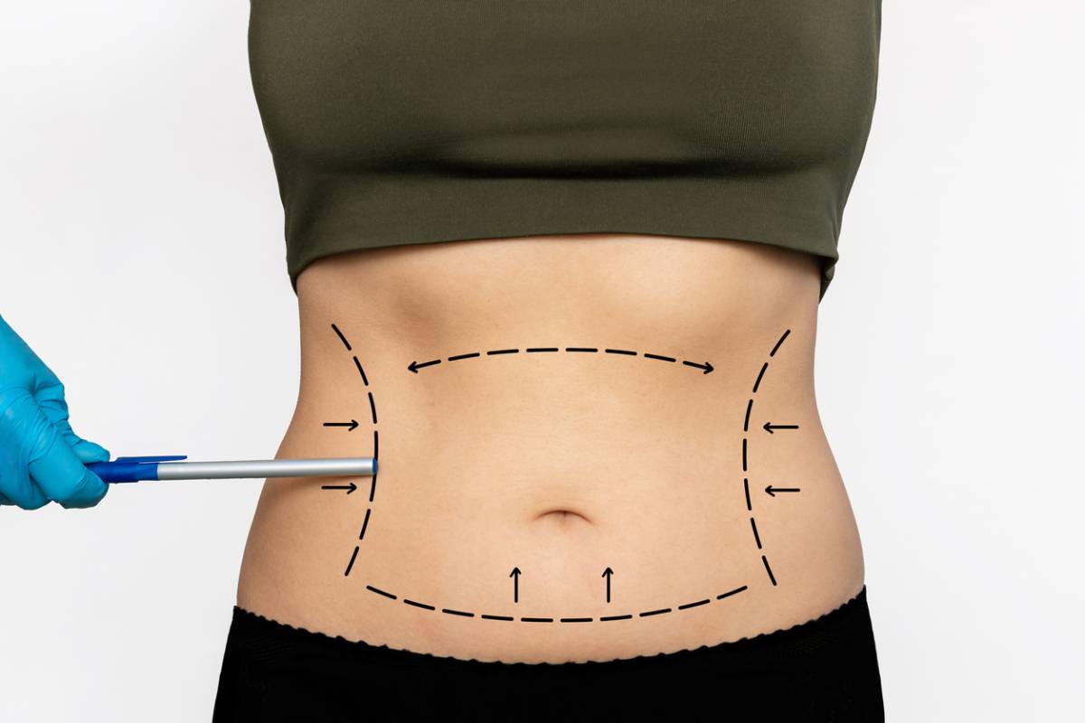 Liposuction Procedure Steps  American Society of Plastic Surgeons